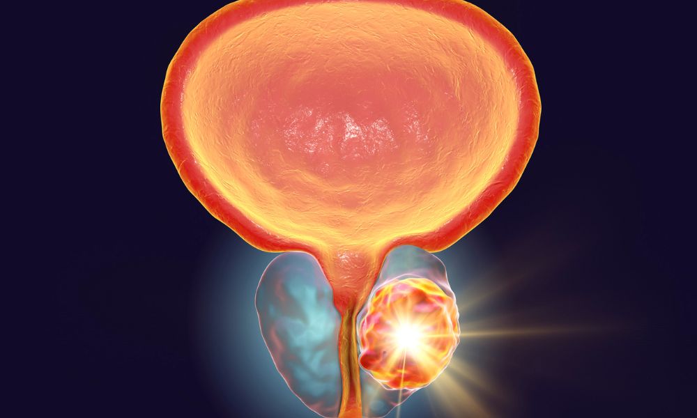 Identificación De Los Síntomas De Próstata Inflamada